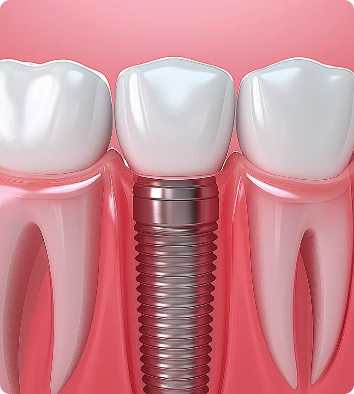 Blog detal implant marketing mobile